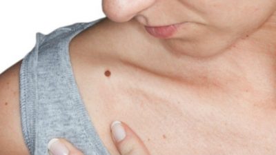 Cara Mencegah dan Mengobati Penyakit Kanker