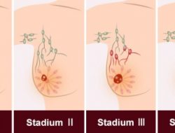Tumbuhan Herbal Ini Ampuh Hancurkan Sel Kanker