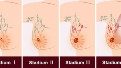 Tumbuhan Herbal Ini Ampuh Hancurkan Sel Kanker